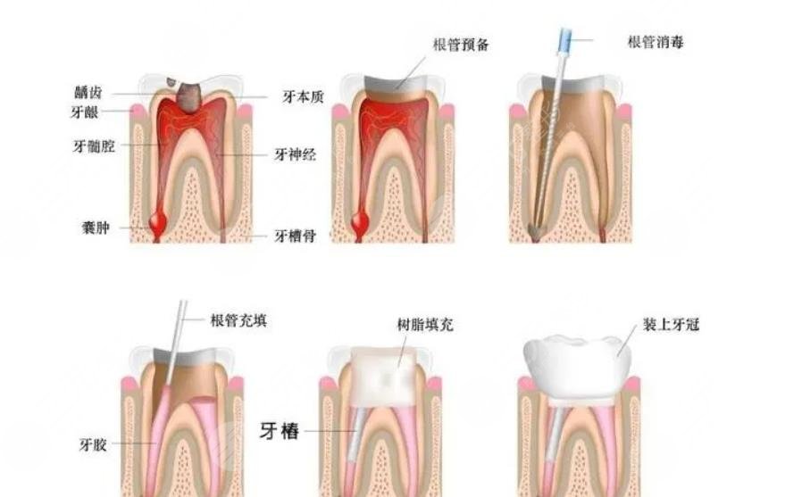 牙周炎的癥狀有哪些?