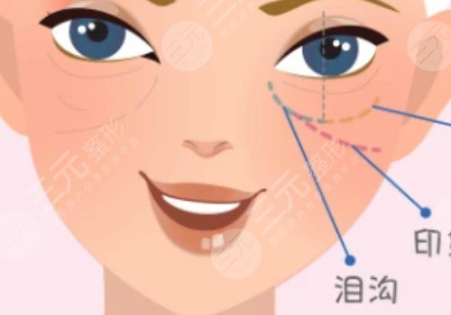淚溝是怎么形成的？