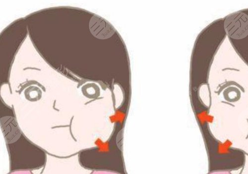 咬肌太大怎么辦如何讓咬肌變??？