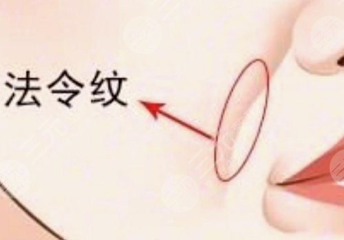 法令紋太深了有什么解決辦法？