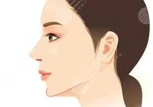 下頜角手術(shù)后頭套要戴多久？