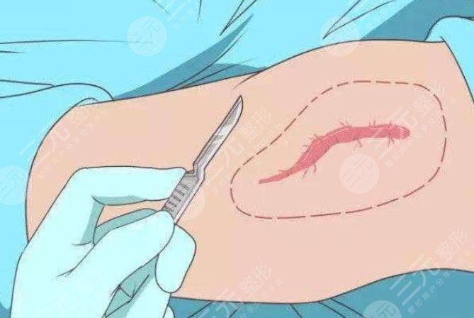 大腿疤痕