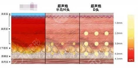 外輪廓固定提升打什么針？