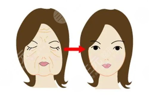 韌帶提升和拉皮的區(qū)別是什么？