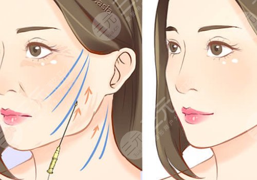 韌帶提升和拉皮的區(qū)別是什么？
