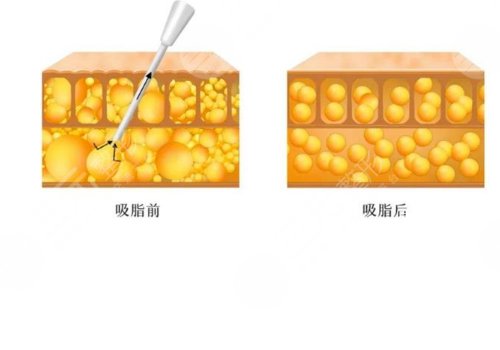 吸脂凹凸不平多久恢復(fù)？