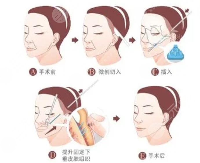 雙燕尾拉皮是怎么做