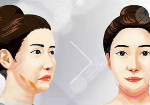 下頜緣提升有什么效果？