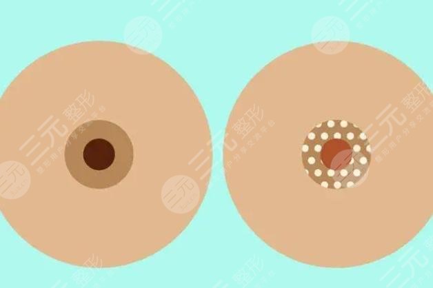 乳頭變形