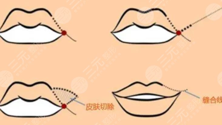 下唇厚外翻整形手術(shù)怎么做？科普及費(fèi)用價(jià)格參考！