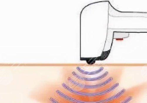 fotona4D全臉多少錢？