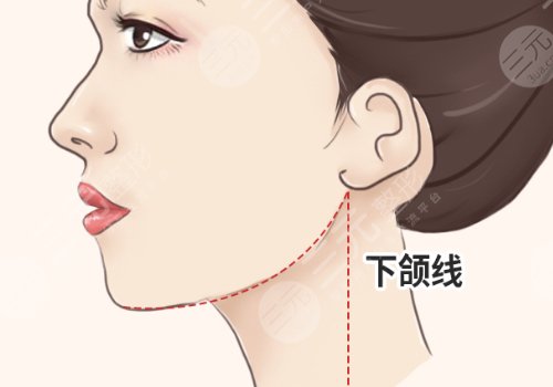 下頜線提升前后對比圖