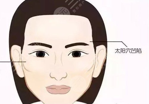 玻尿酸填充太陽凹大概多少錢？