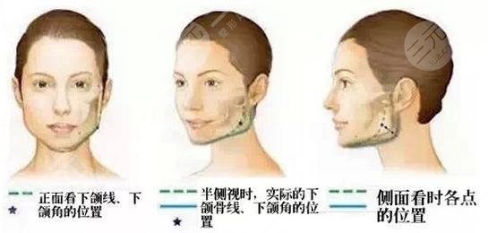 吳中興下頜角手術(shù)怎么樣？