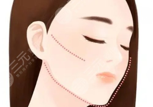 做完輪廓手術臉更大了怎么回事？