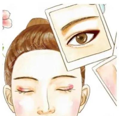 深圳人民醫(yī)院孫輝雙眼皮案例
