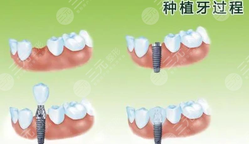 長(zhǎng)庚醫(yī)院種植牙案例