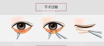 微調(diào)整形大概多少錢？