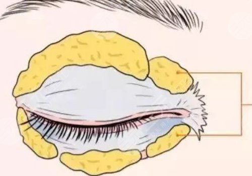 腫眼泡抽脂多少錢？