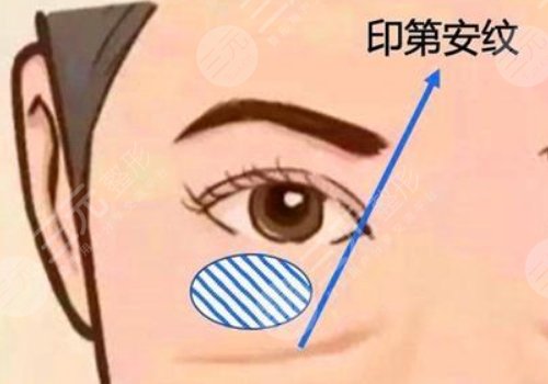 印第安紋和淚溝的區(qū)別是什么？