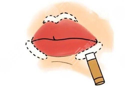唇部填充用脂肪還是玻尿酸？