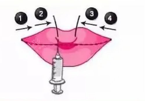 唇部填充用脂肪還是玻尿酸？