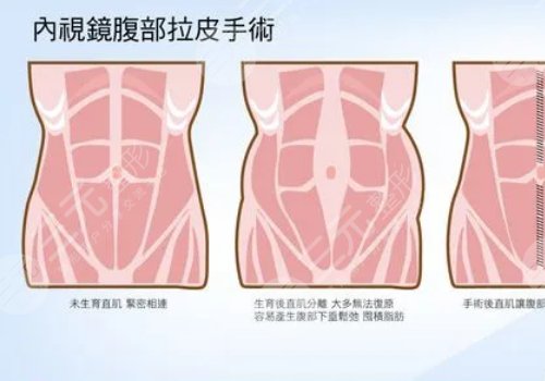 腹部拉皮和腹壁整形一樣嗎？