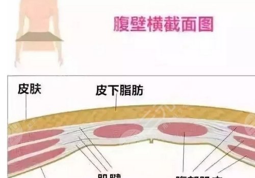 腹部拉皮和腹壁整形一樣嗎？
