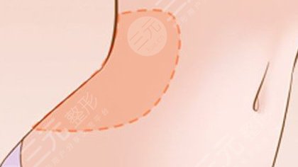 腰腹環(huán)吸包括哪幾個部位？