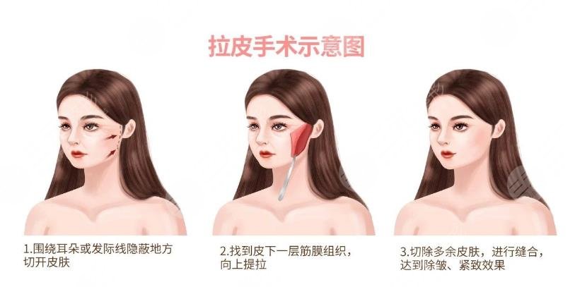 雙矢量組織復(fù)位術(shù)