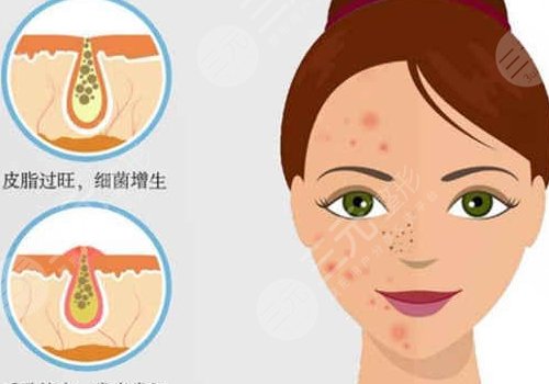 t區(qū)反復(fù)長痘痘的原因是什么？