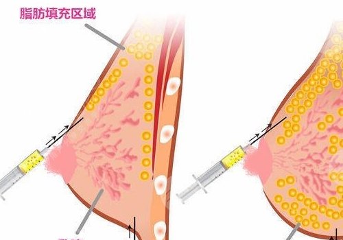 胸型不好看可以調(diào)整嗎？