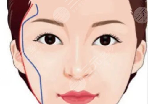 顴弓吸脂有什么后遺癥？