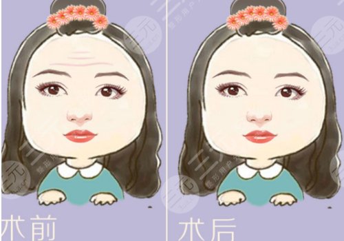 抬頭紋怎么去除？