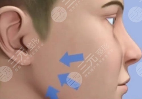 外輪廓固定提升有哪些手術(shù)方案？