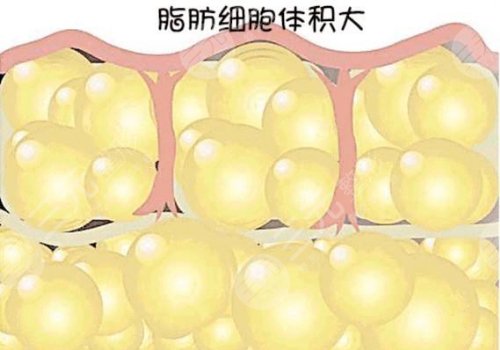 自體隆胸可以保持幾年？