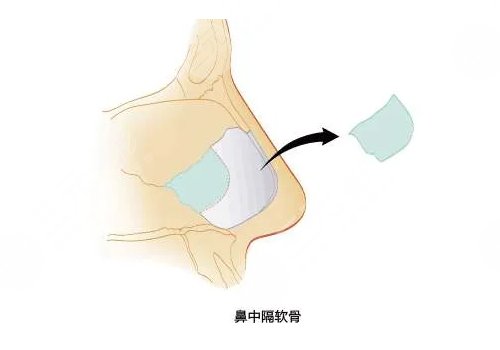 靳玉彪做的鼻子怎么樣？