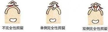 唇裂修復(fù)
