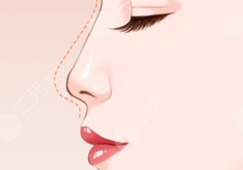 翹鼻和直鼻哪個好看？
