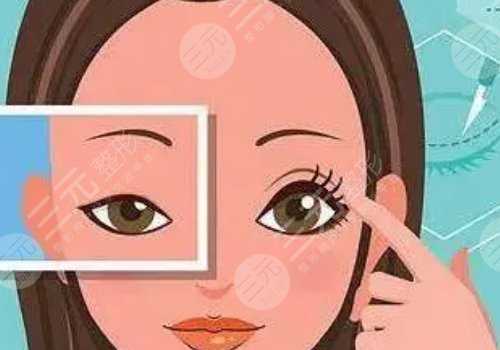 廣州顏玲雙眼皮案例