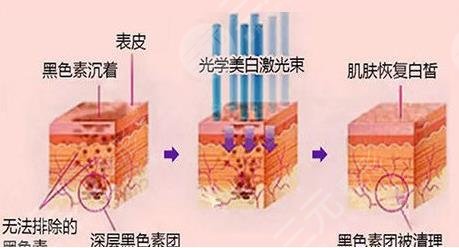 光子嫩膚m22多少錢啊