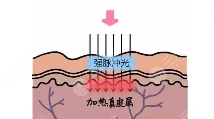 光子嫩膚m22多少錢啊