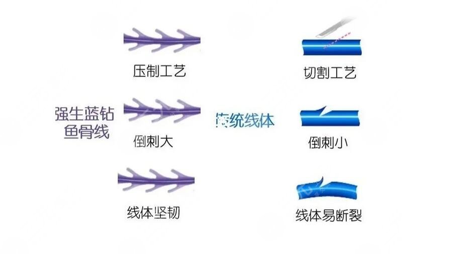 美國強生魚骨線雕多少錢？