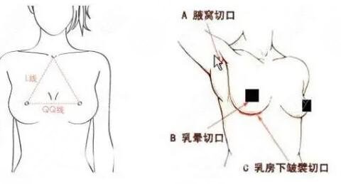 假體隆胸切口在什么位置比較好？常用三個(gè)切口位置，優(yōu)缺點(diǎn)告訴你！