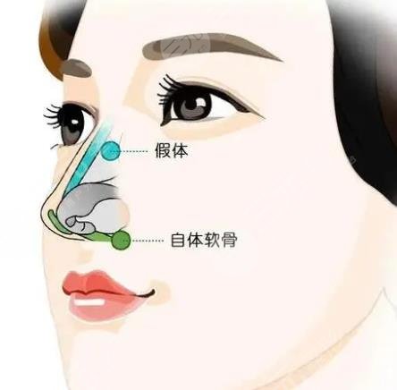 上海第六人民醫(yī)院隆鼻案例