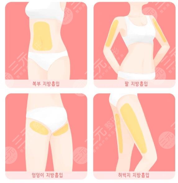 全身抽脂可以保持多久？