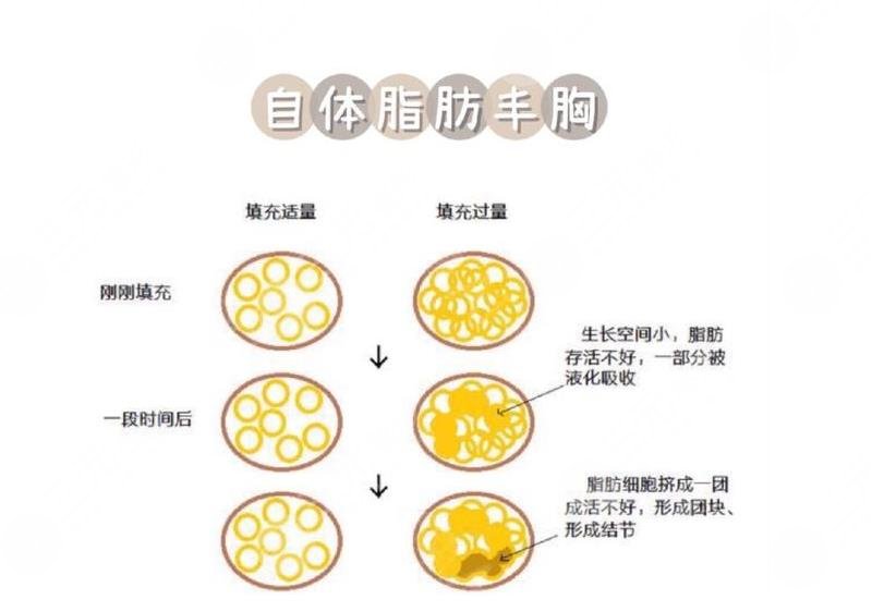 北京韓興斌隆胸怎么樣?