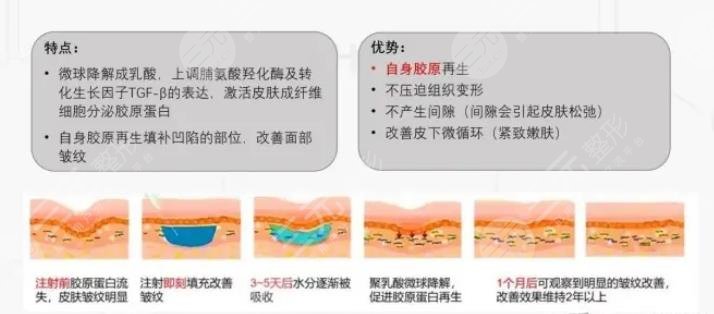 艾維嵐注射后多久消腫？