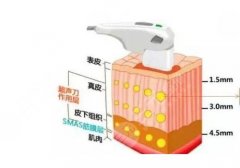 半島超聲炮的功效和作用有哪些？恢復時間曝光！