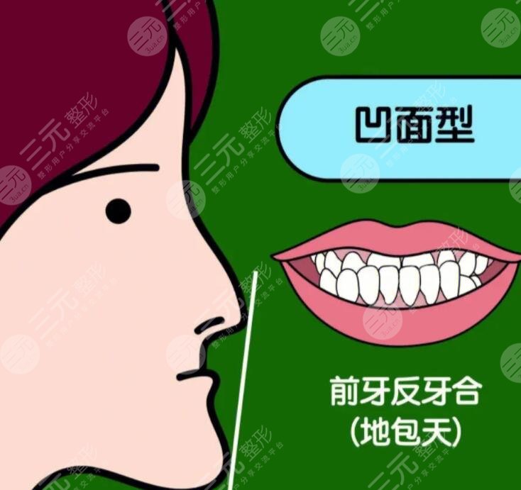 成人地包天手術(shù)整形費(fèi)用多少錢？2023年市場均價1-3萬不等~